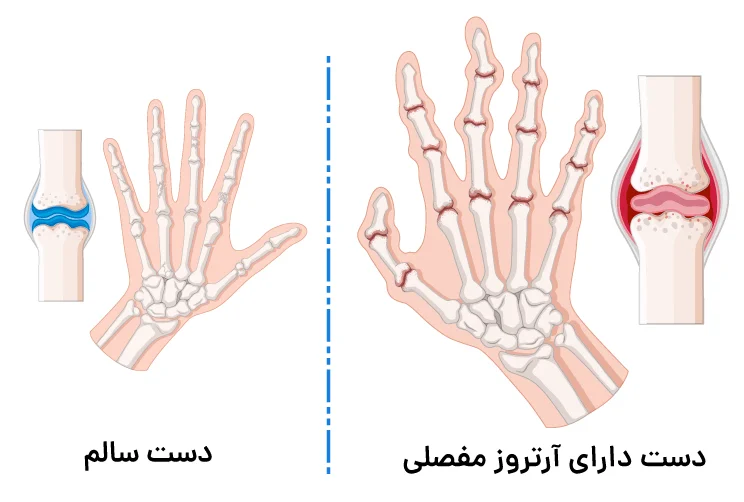 حقایق مهم درباره آرتروز دست